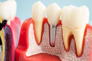 Implante dental