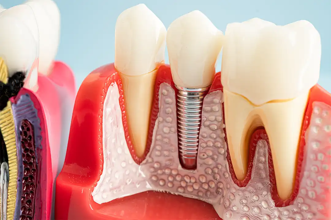 Implante dental